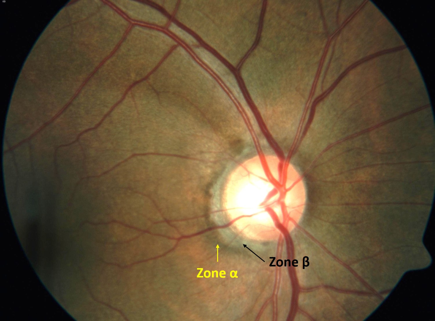 Optic Nerve Evaluation In Glaucoma California Optometric Association 